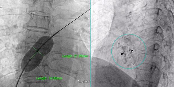 Kích thước lỗ thông 22cm qua kết quả thông tim dưới màn tăng sáng và hình sau can thiệp bít lỗ thông bằng dụng cụ dù. Kích thước lỗ thông 22cm qua kết quả thông tim dưới màn tăng sáng và hình sau can thiệp bít lỗ thông bằng dụng cụ dù.