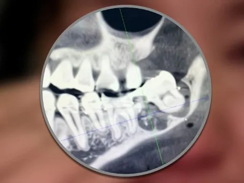 Nhày lầu tự tử sau khi bác sĩ... nhổ nhầm răng khôn nhưng chối bỏ trách nhiệm