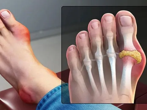 Nghiên cứu quy mô toàn cầu vén màn sự thật bất ngờ về bệnh gút: Không chỉ do ăn uống