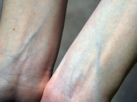 Vì sao máu luôn đỏ nhưng tĩnh mạch lại xanh?